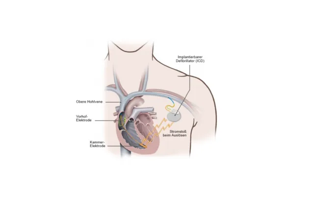 defibrillator-at-pacemaker-and-icd